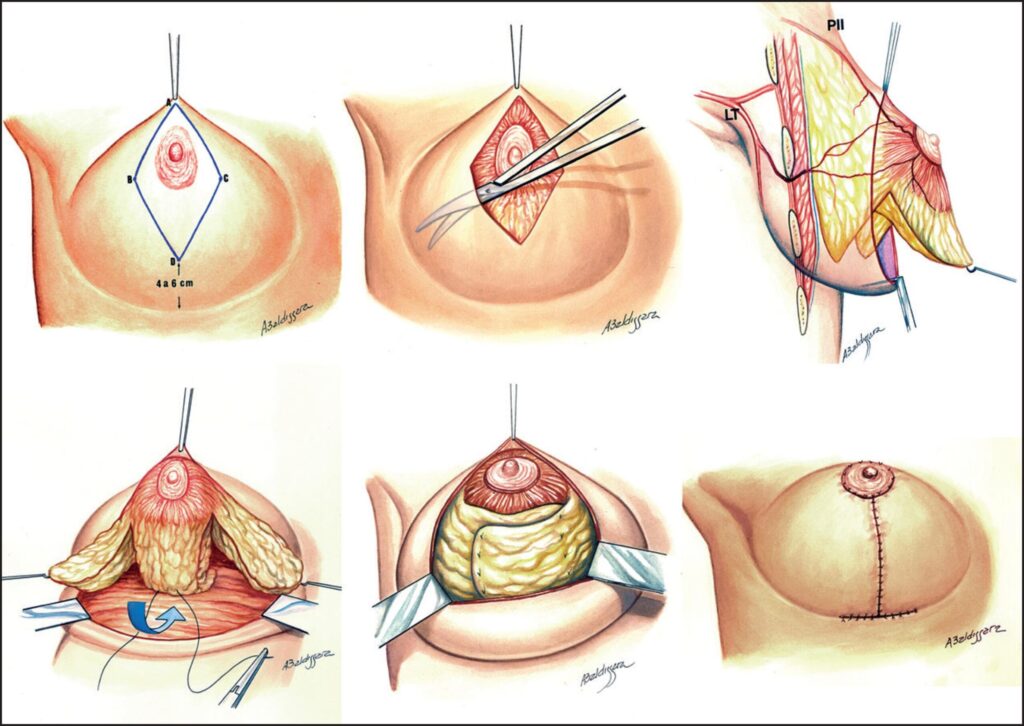 Diagrama del proceso de lipotransferencia mamaria para aumento de senos