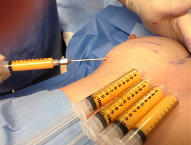 Inyección de Grasa en los Senos para la Lipotransferencia Mamaria